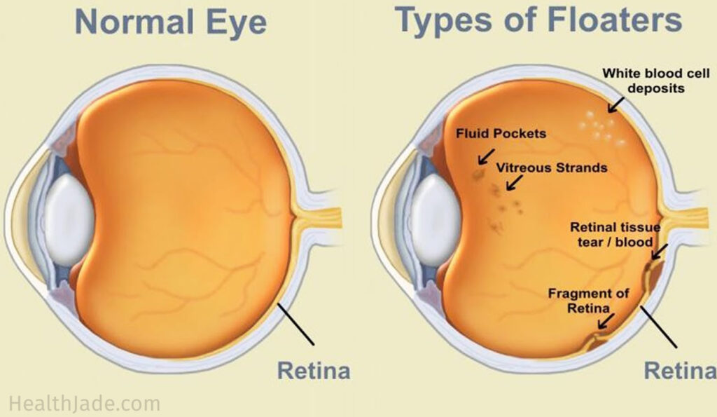 Floaters Cataract Laser Institute Eye Doctor In Medford Oregon